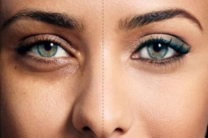 dark circle reduction