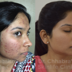 acne-scar-reduction