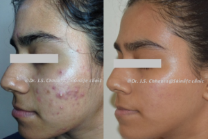 acne scars reduction treatment