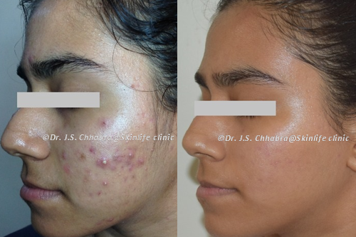 Skin Hair Laser Centre in Indore - Dr. Chhabra's Skin Life Clinic