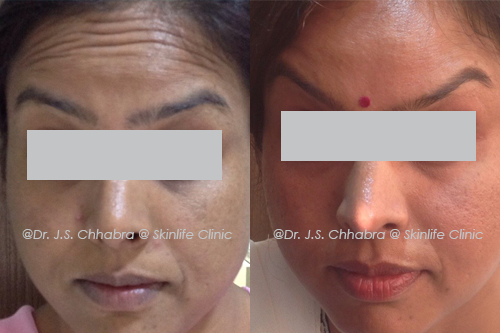 anti ageing treatment