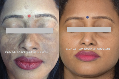Skin Care Procedures - Dr. Chhabra's Skin Life Clinic, Indore