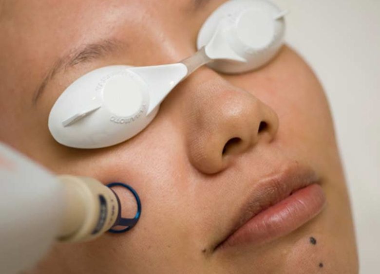 5 Things to Know Before Getting Laser Hair Removal