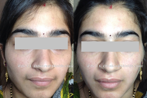 laser hair reduction treatment