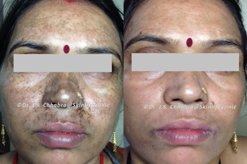 pigmentaion reduction treatment