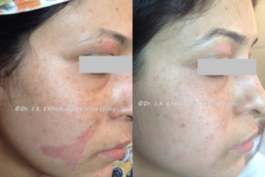 scar reduction treatment