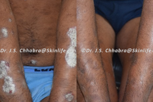 psoriasis treatment indore