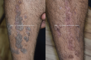 eczema treatment indore