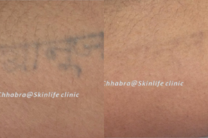 tattoo removal services