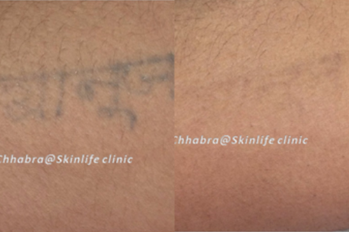 tattoo removal services
