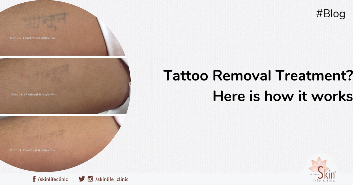 Tattoo Removal Treatment? Here is how it works