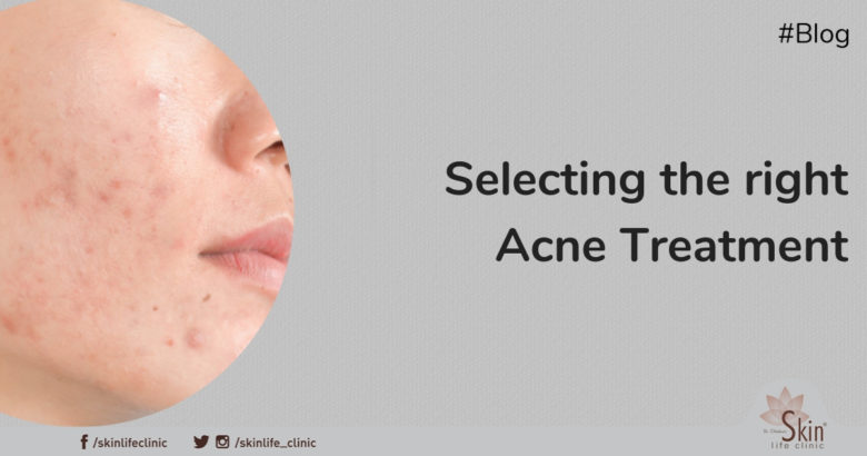 Selecting the Right Acne Treatment