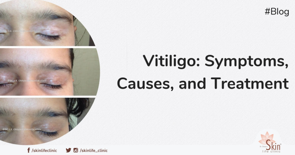Vitiligo: Symptoms, Causes, and Treatment