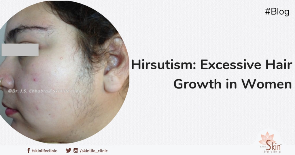 Hirsutism: Excessive Hair Growth in Women (Condition and Treatment)