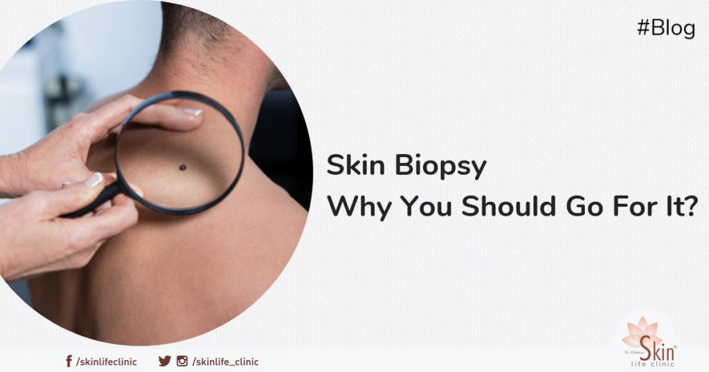 Skin Biopsy: Why You Should Go For It?