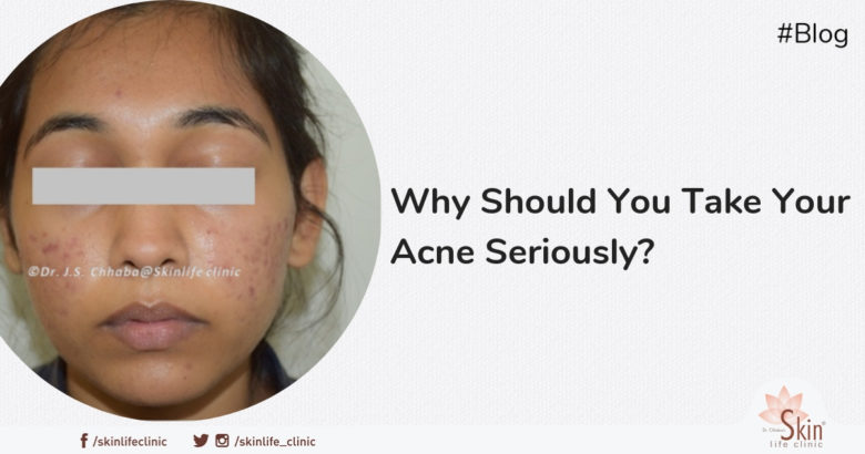 Why Should You Take Your Acne Seriously