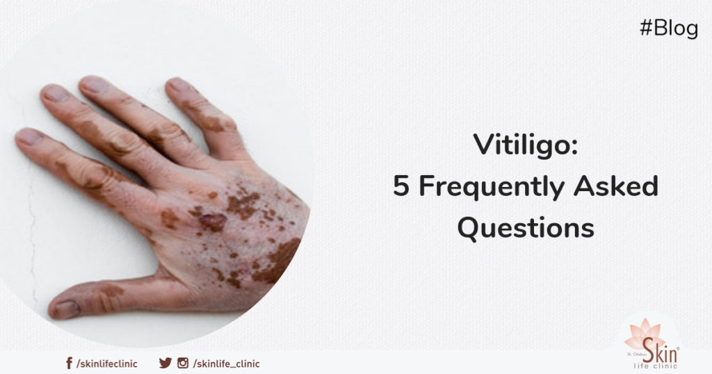 Vitiligo - 5 Frequently Asked Questions