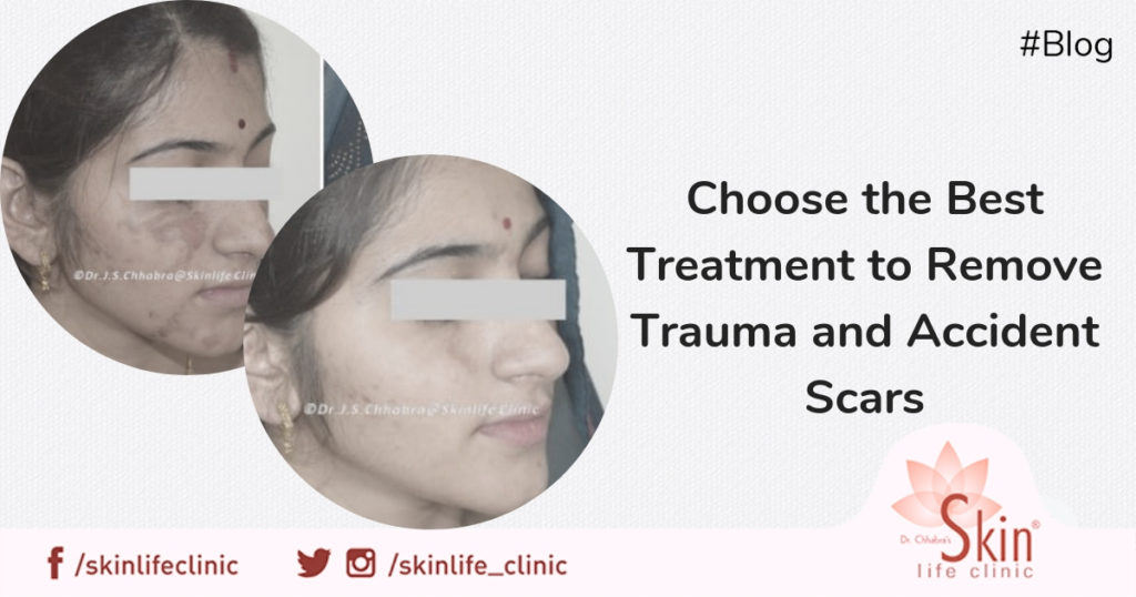 Choose the Best Treatment to Remove Trauma and Accident Scars