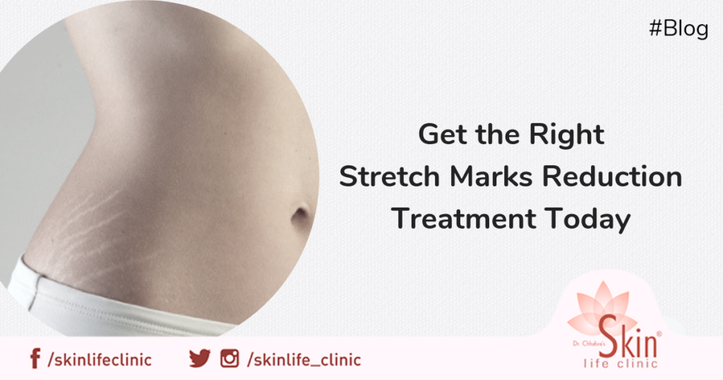 Get the Right Stretch Marks Reduction Treatment Today