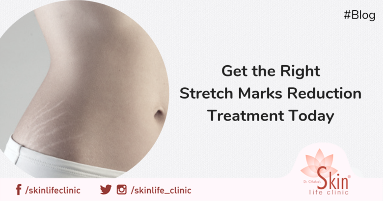 Get the Right Stretch Marks Reduction Treatment Today