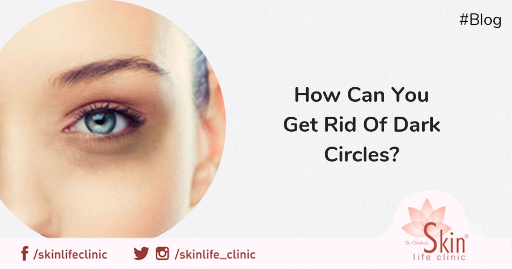 How Can You Get Rid Of Dark Circles