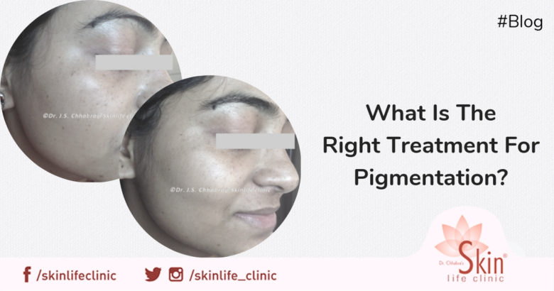 Pigmentation: What Is The Right Treatment For It