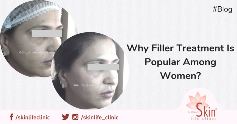Why Filler Treatment Is Popular Among Women