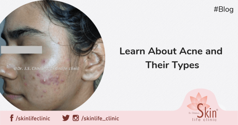Learn About Acne and Their Types