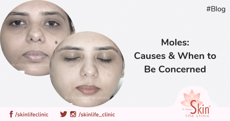 Moles Causes & When to Be Concerned