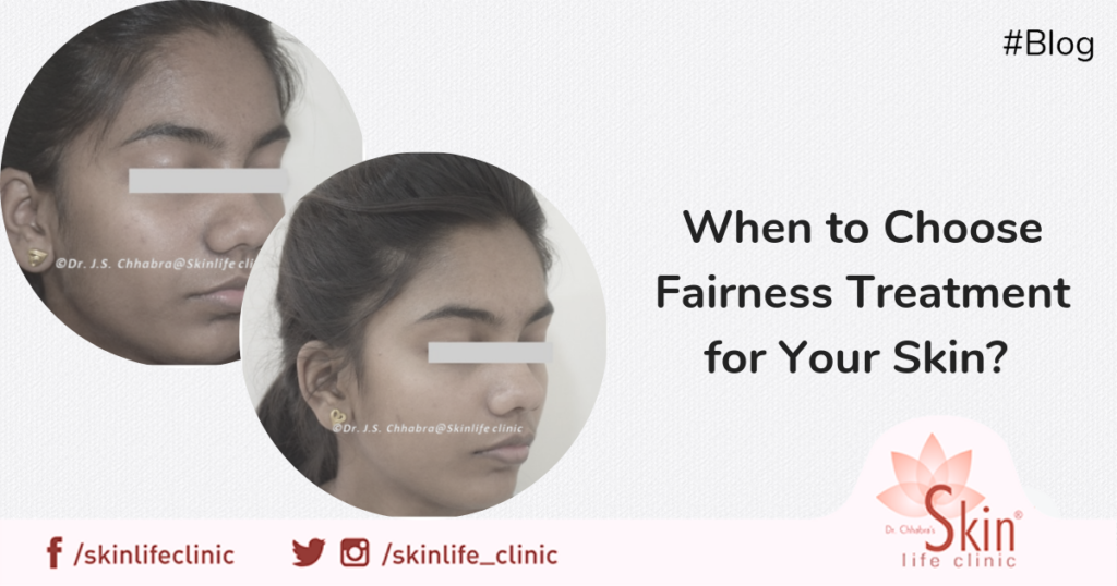 When to Choose Fairness Treatment for Your Skin