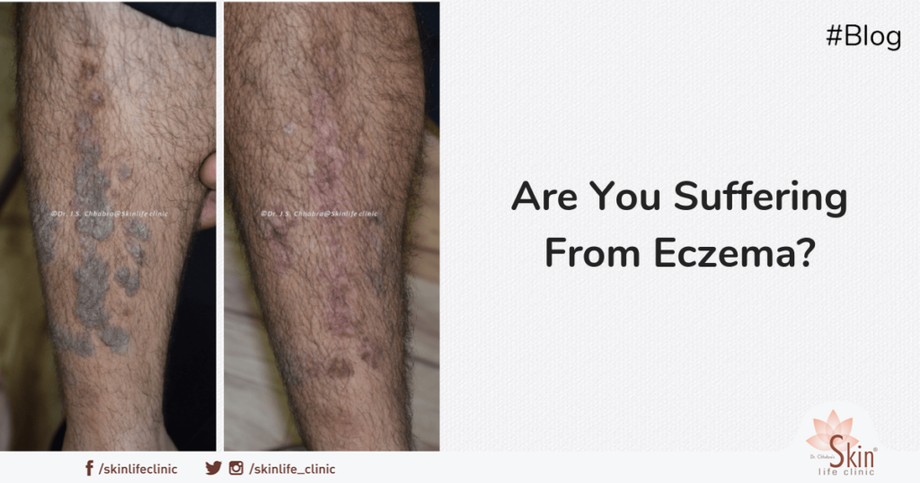 Are You Suffering From Eczema