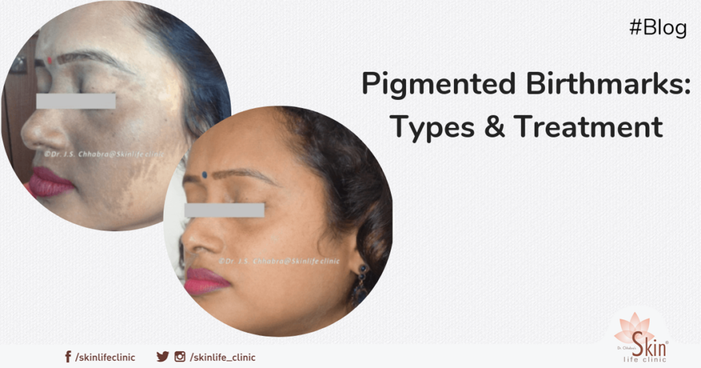 Pigmented Birthmarks Types and Treatment