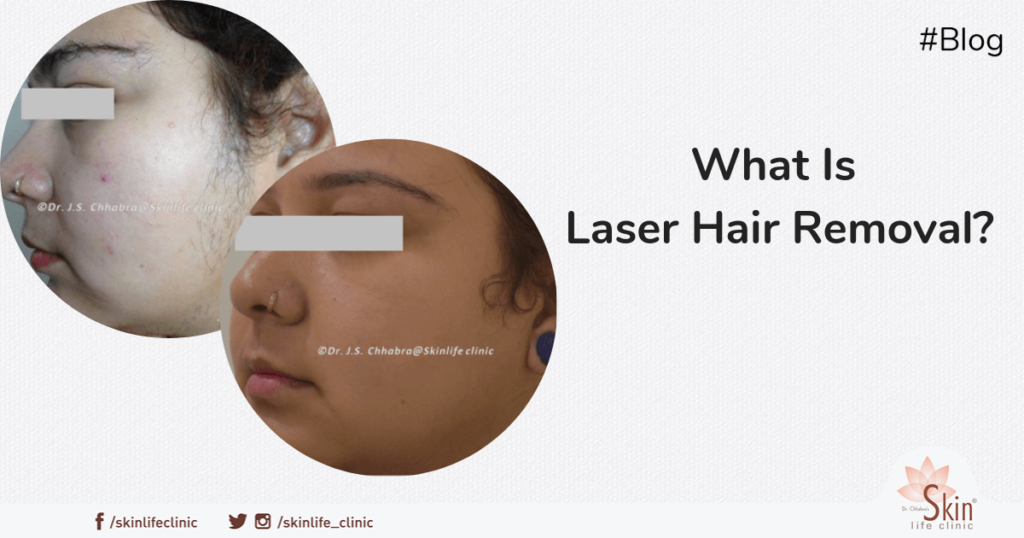 What Is Laser Hair Removal Treatment